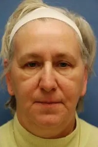 Facelift Before & After Patient #432