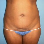 Liposuction Before & After Patient #511