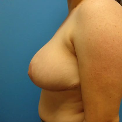 Breast Reduction Before & After Patient #306
