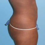 Liposuction Before & After Patient #511