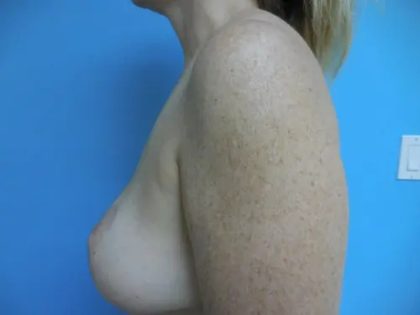 Breast Lift Before & After Patient #563