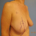Breast Lift Before & After Patient #563