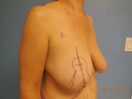 Breast Lift Before & After Patient #563