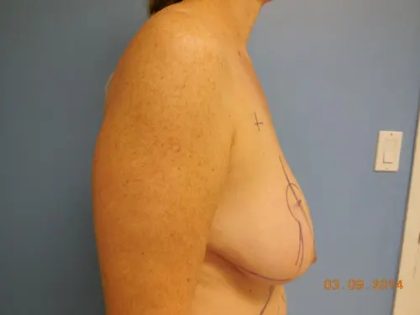 Breast Lift Before & After Patient #563