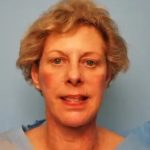 Facelift Before & After Patient #435