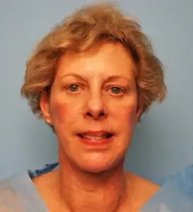 Facelift Before & After Patient #435