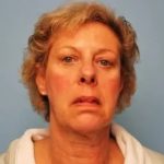 Facelift Before & After Patient #435