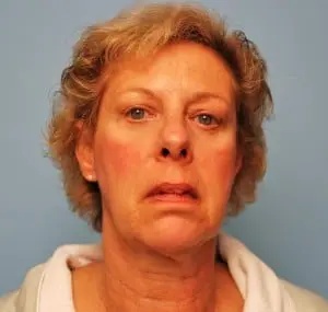 Facelift Before & After Patient #435