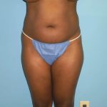 Liposuction Before & After Patient #516