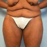 Breast Lift Before & After Patient #568