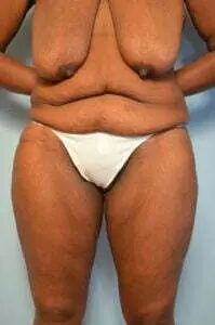 Breast Lift Before & After Patient #568