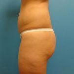 Coolsculpting Before & After Patient #379