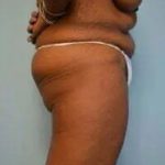 Breast Lift Before & After Patient #568