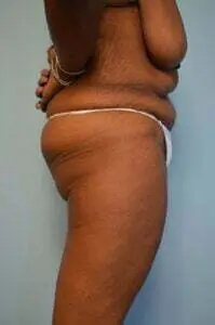 Breast Lift Before & After Patient #568