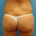 Coolsculpting Before & After Patient #379