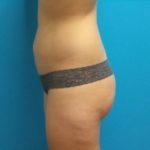Coolsculpting Before & After Patient #379