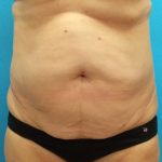 Coolsculpting Before & After Patient #384