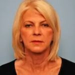 Facelift Before & After Patient #438