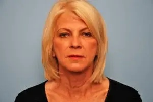 Facelift Before & After Patient #438