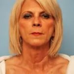 Facelift Before & After Patient #438
