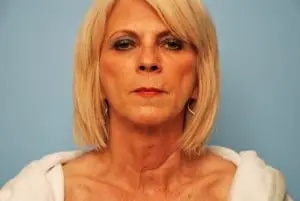 Facelift Before & After Patient #438