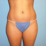 Liposuction Before & After Patient #521