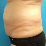 Coolsculpting Before & After Patient #384