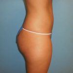 Liposuction Before & After Patient #521