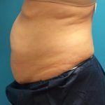Coolsculpting Before & After Patient #384