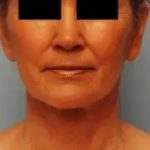Facelift Before & After Patient #441