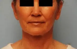 Facelift Before & After Patient #441