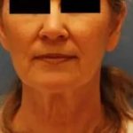 Facelift Before & After Patient #441