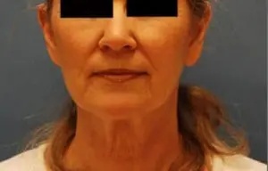 Facelift Before & After Patient #441