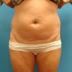 Liposuction Before & After Patient #526