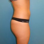 Coolsculpting Before & After Patient #391