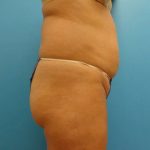 Liposuction Before & After Patient #526