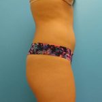 Coolsculpting Before & After Patient #391