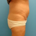 Liposuction Before & After Patient #526