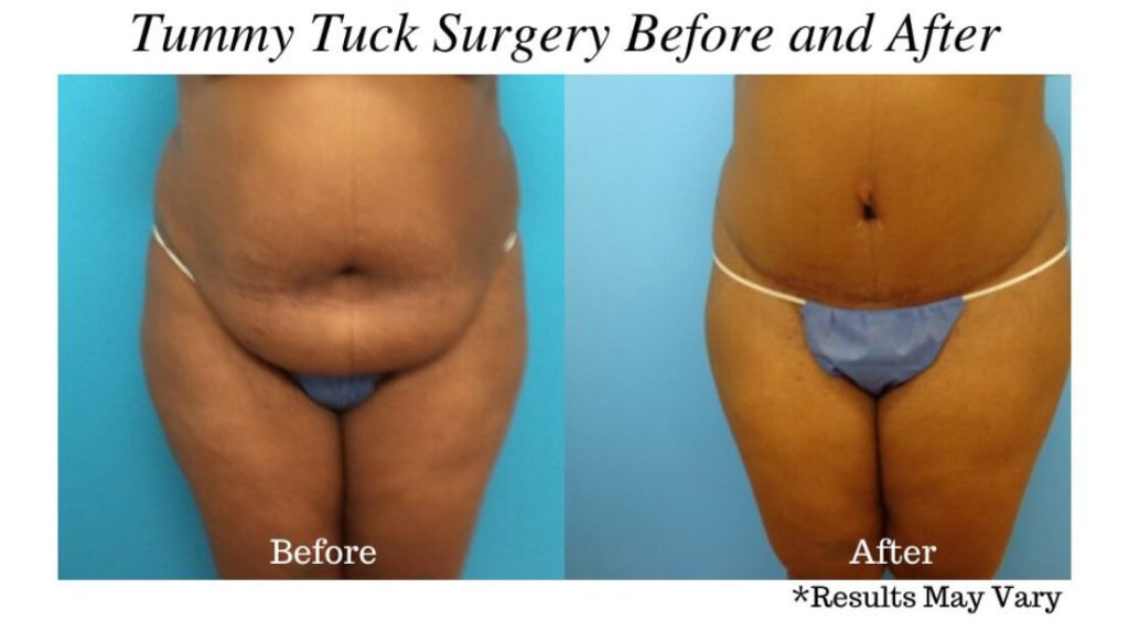 Before and after image showing the results of a tummy tuck performed in Tampa, FL.